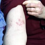 Egzama Tedavisi: Modern Yöntemler ve İlaç Desteği