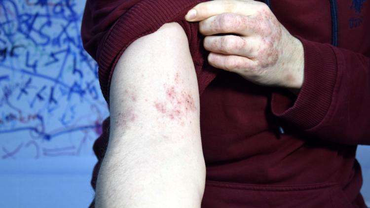 Egzama Tedavisi: Modern Yöntemler ve İlaç Desteği