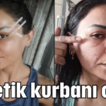 Estetik kurbanı oldu