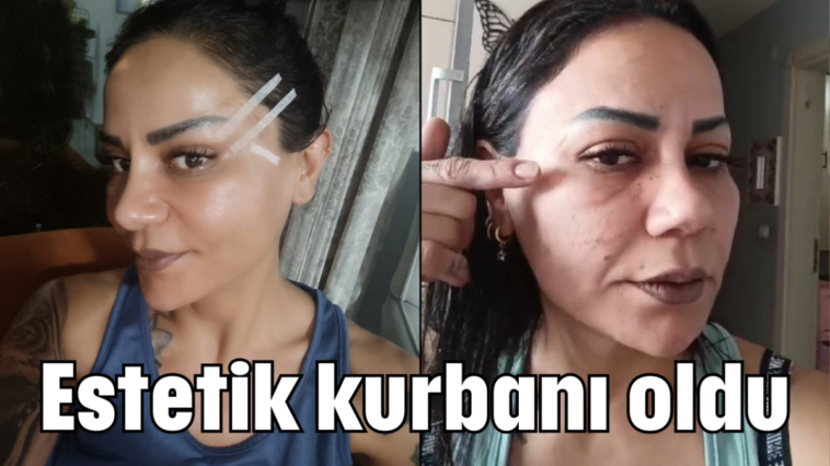 Estetik kurbanı oldu