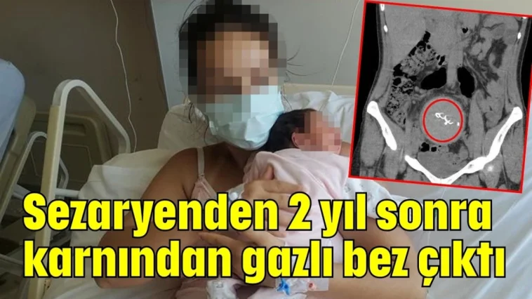 Sezaryenden 2 yıl sonra karnından gazlı bez çıktı