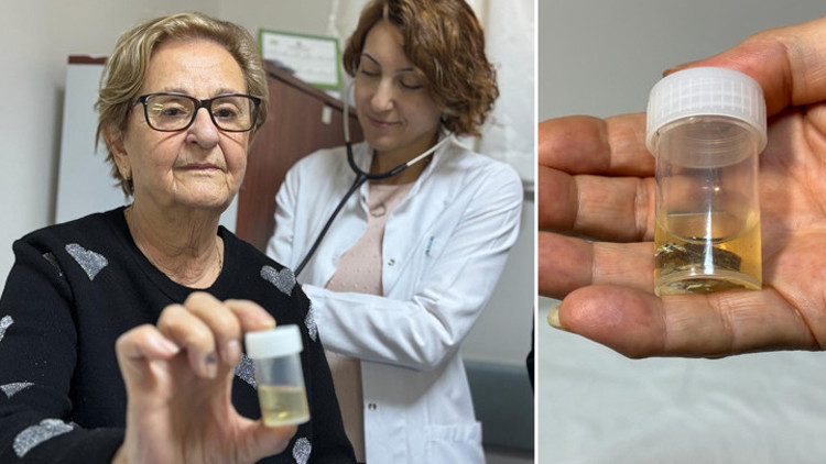 Antalyada ilginç olay Hapı alüminyum kabıyla yuttu, 4 yıl sonra akciğerinden bütün halinde çıkarıldı... Meğer hapı yutmuşum